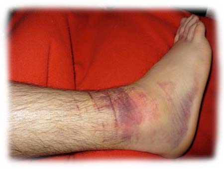 Ankle_Swelling