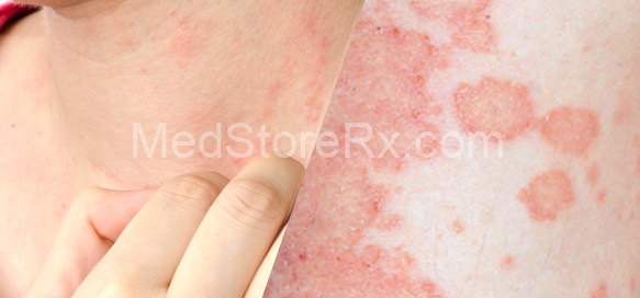 Blog-Bacterial-Skin-Infections-Over-Health