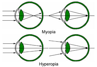 Myopia_and_Hyperopia