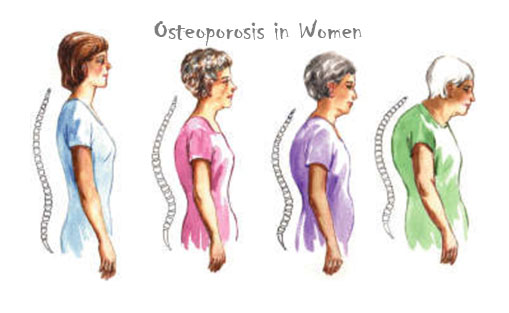 Osteoporosis in women