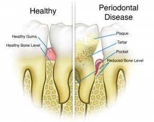 Periodontal Disease_2