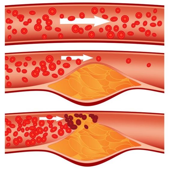 what-causes-hardening-and-narrowing-of-arteries