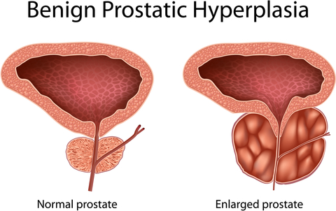 benign-prostatic-hyperplasia