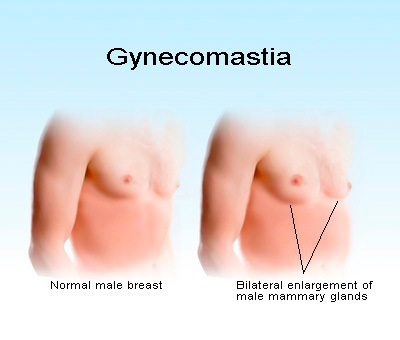 gynecomastia